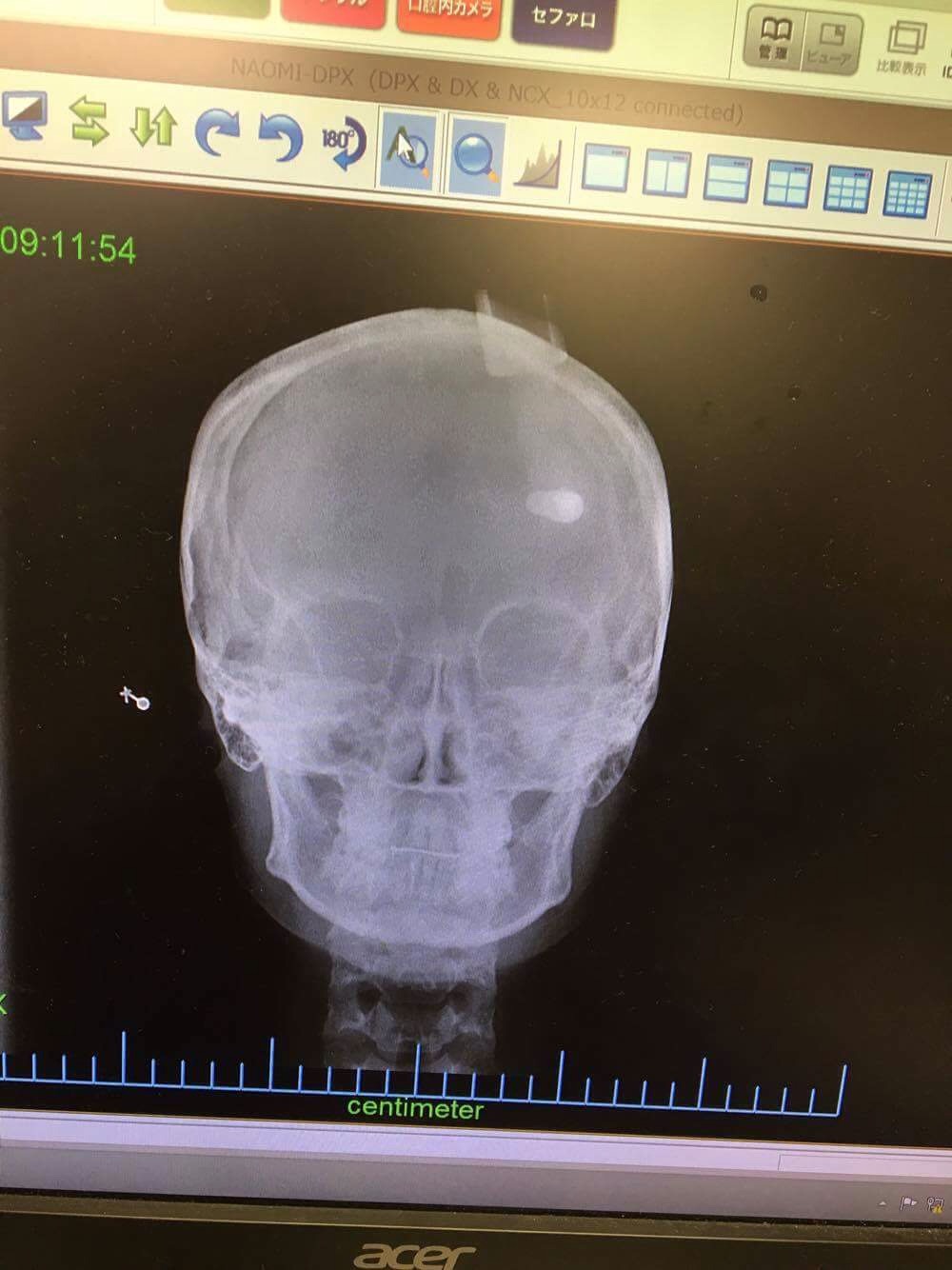 X-ray nicely showcasing the crookedness of my jaw